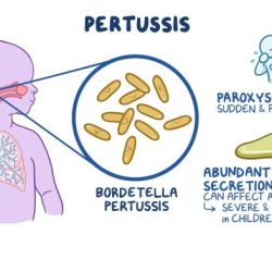 A paroxysmal cough is associated with legionnaires' disease