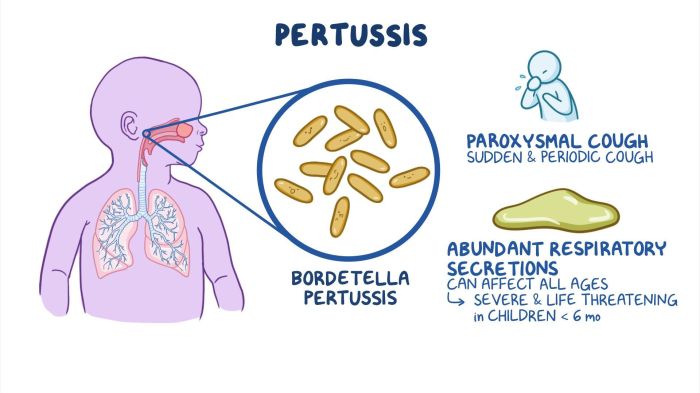 A paroxysmal cough is associated with legionnaires' disease